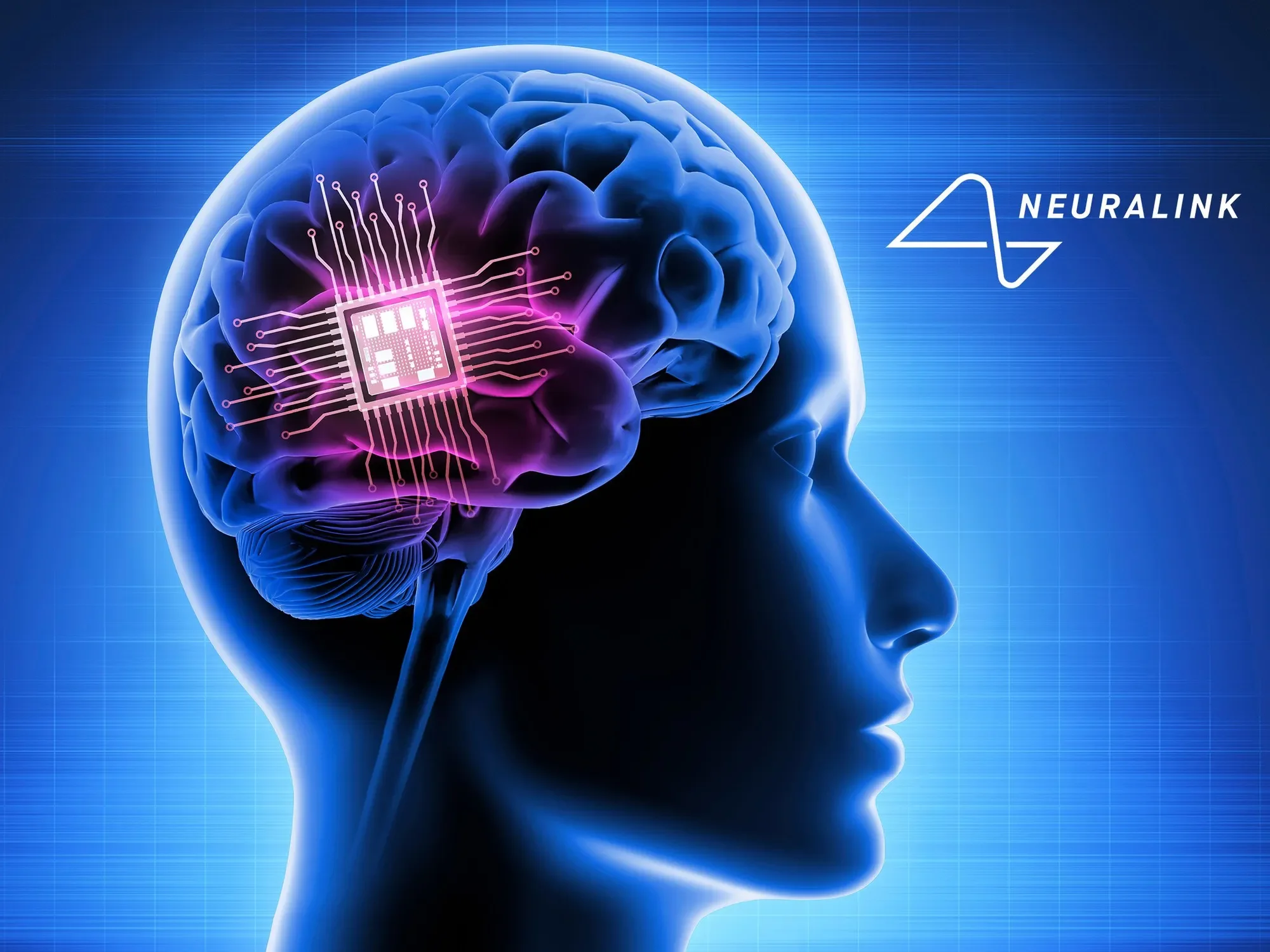 Neuralink brain interface implant and surgical robot inserting ultra-thin electrode threads into the brain